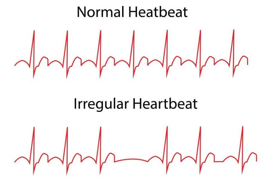 Abnormal Heart Rates