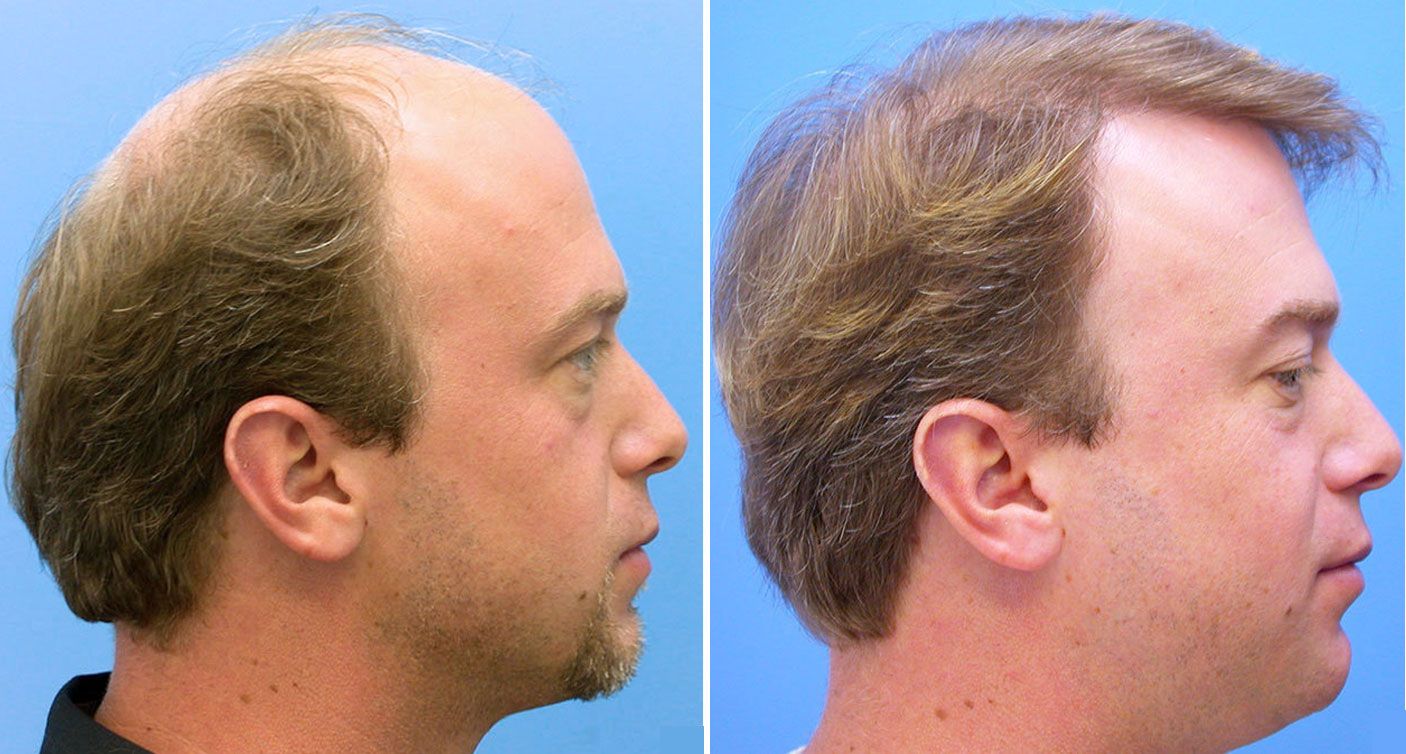Пересадка волос выпадают волосы. Прически при облысении у мужчин. Последствия пересадки волос.