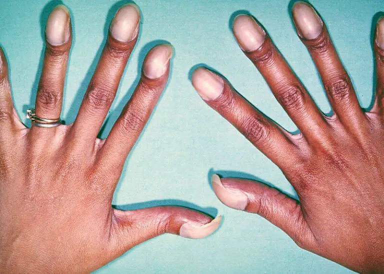 How Your Nail Can Help To Diagnose A Disease