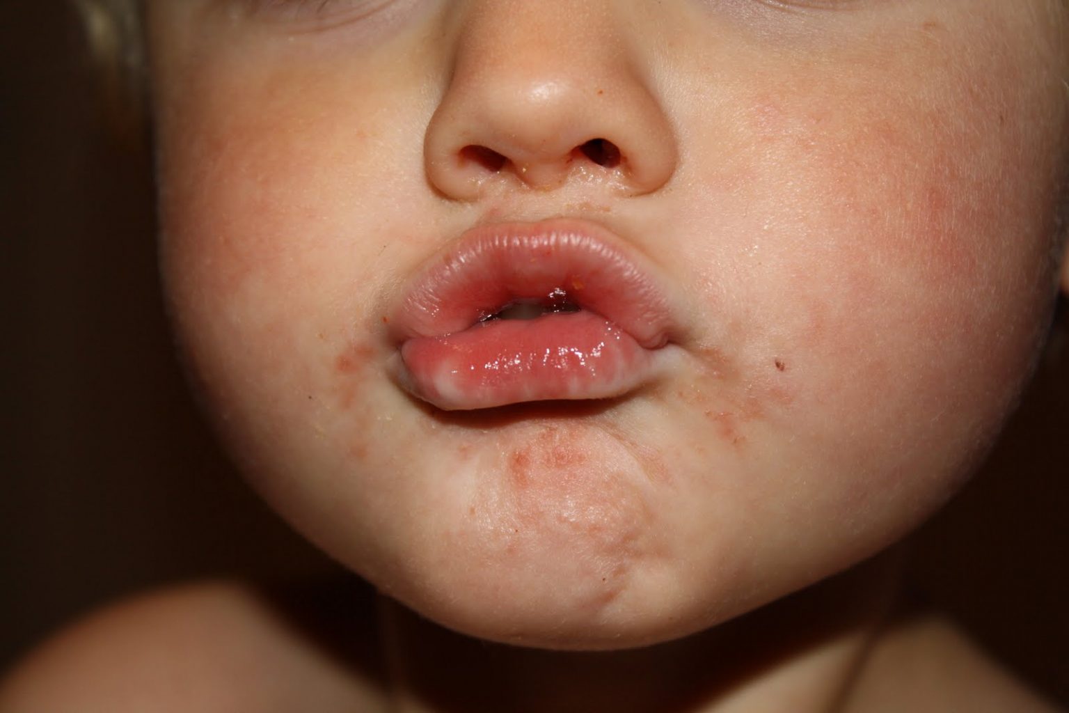 Hand, Foot, And Mouth Disease In Children