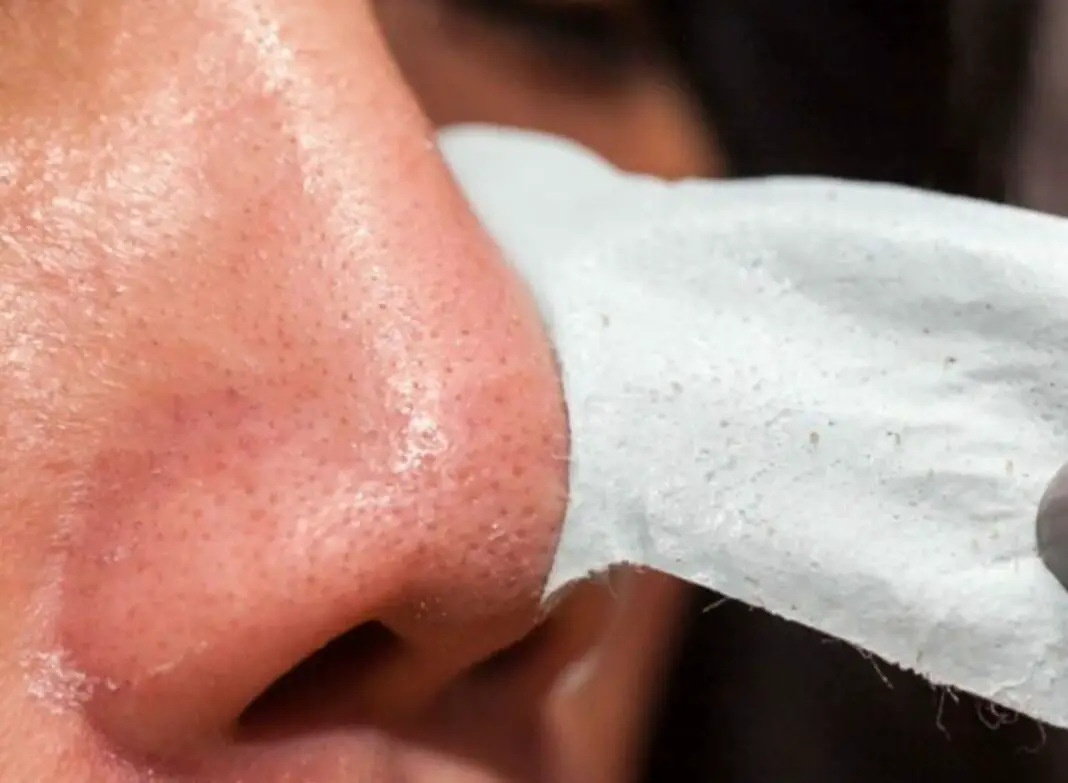 Tips on How to Get Rid of Blackheads And Whiteheads