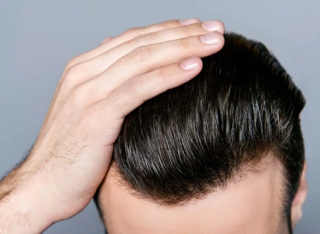 things you must know before getting a hair transplant