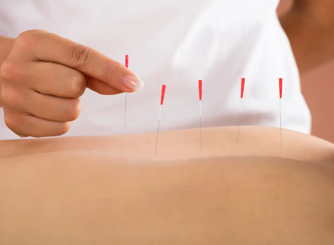 Key Benefits of Dry Needling Physical Therapy